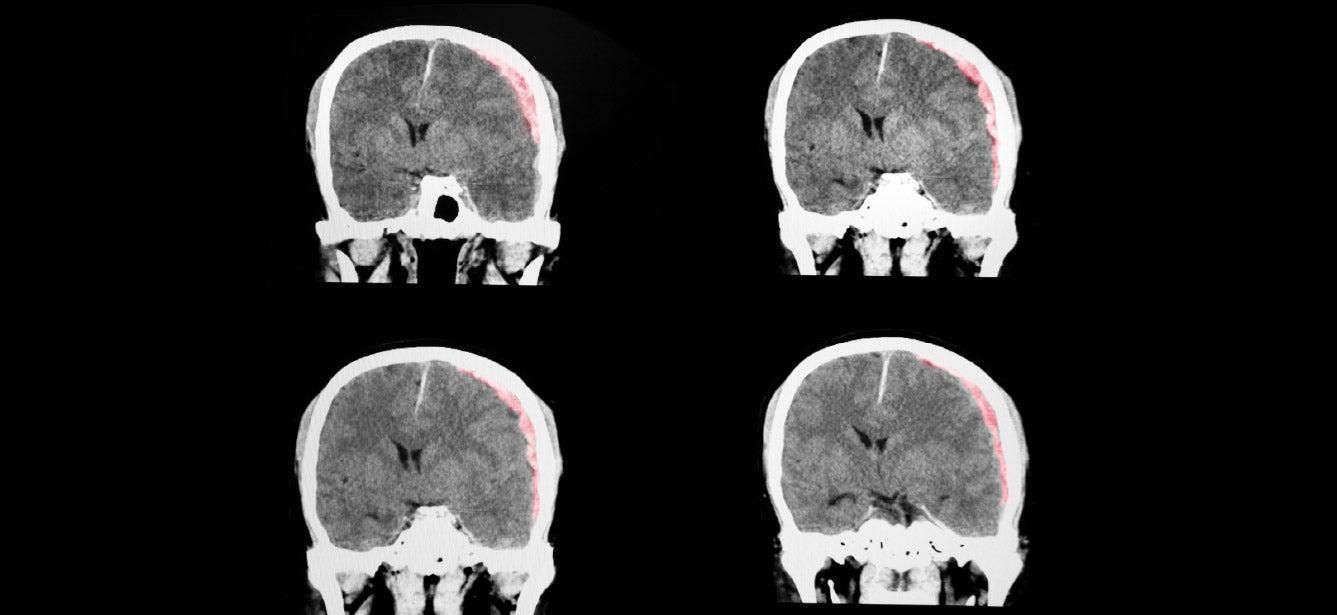 Traumatic Brain Injury Mental Health Symptoms in Older Adults