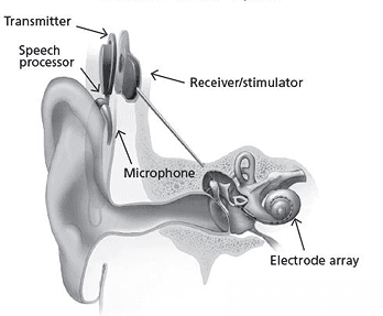 cochlear implant