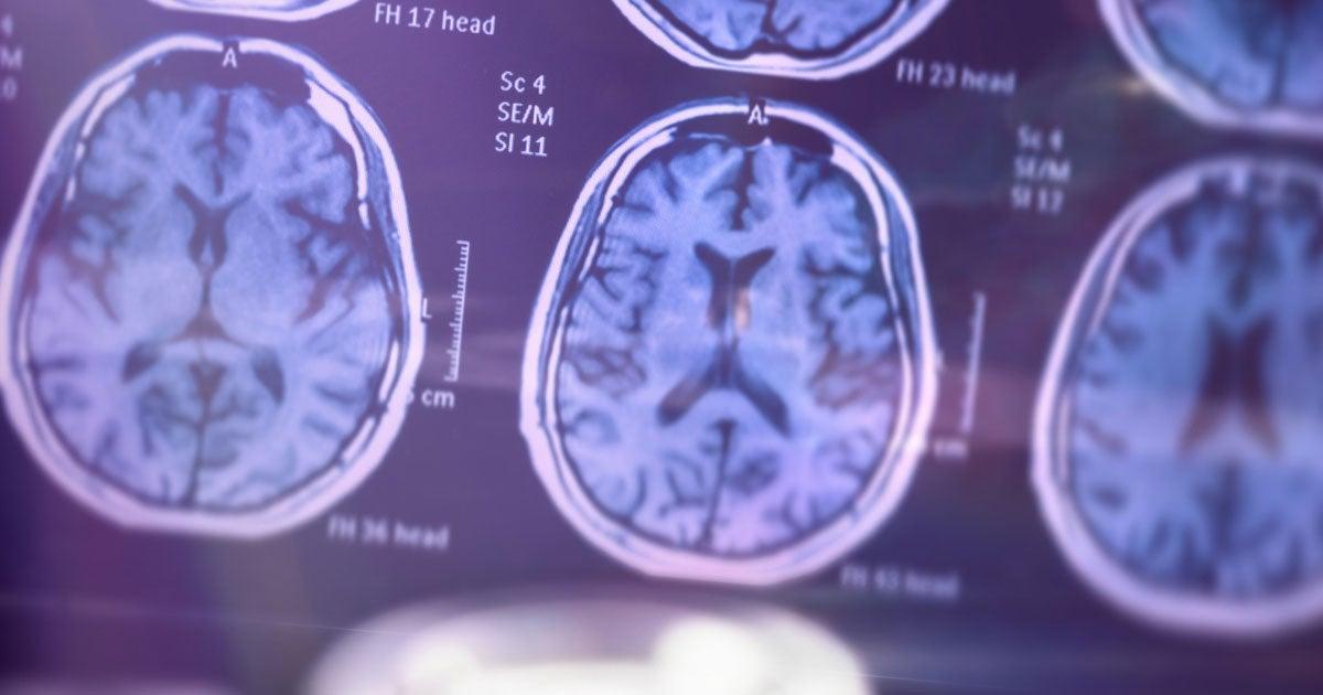 A close-up of several brain scan images, possibly MRI scans, displayed on a screen. The scans show detailed cross-sectional views of the brain with various anatomical features visible. The images have a bluish tint, and some text and measurements are visible alongside the scans, indicating technical information. The overall focus is on the structure and health of the brain